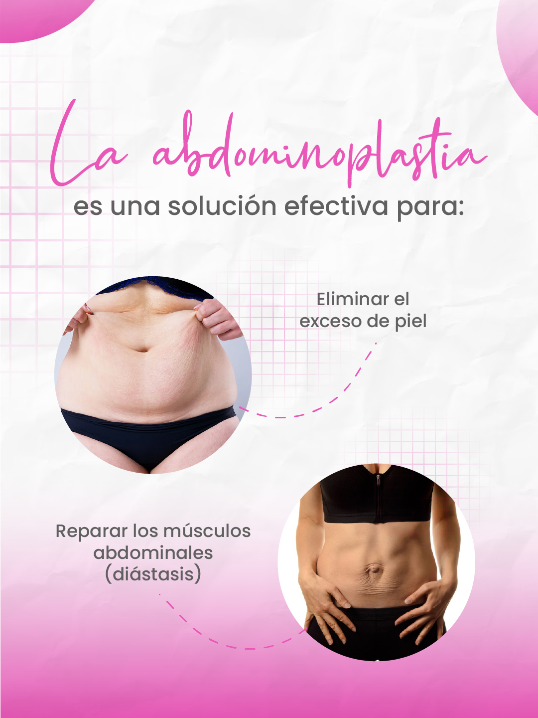 La abdominoplastia como solución efectiva: elimina piel y repara músculos