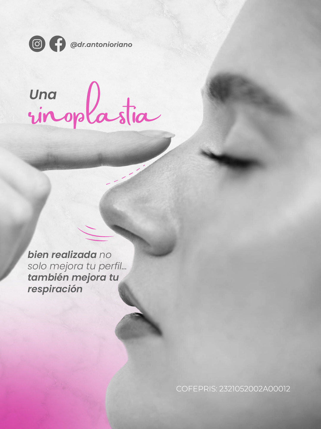 Sabías qué: una rinoplastia bien realizada mejora perfil y respiración